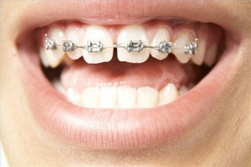 Trái lại, việc dùng dây thun, sợi chỉ tơ có thể mang lại hiệu quả song rủi ro cũng khá nhiều. Chỉ có chỉnh nha chuyên nghiệp mới là lựa chọn tốt nhất.