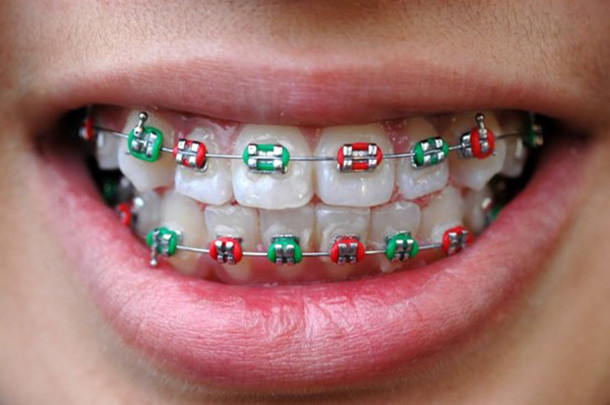 Khi niềng răng, bạn phải mất nhiều năm với các thiết bị chỉnh hình mới có được nụ cười như ý. Đây không phải thủ thuật để các bác sĩ nha khoa “câu tiền” từ khách hàng mà vì răng và nướu khá nhạy cảm, cần thao tác chậm và cẩn trọng.