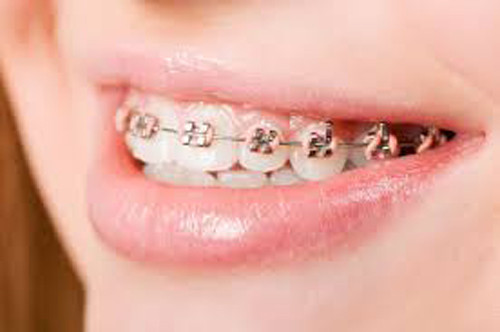Ở Mỹ, khoảng 60% dân số có bảo hiểm nha khoa song hầu hết các công ty bảo hiểm không chi trả cho các khoản liên quan đến niềng răng. Chỉ một vài công ty đồng ý chi trả thì số tiền cũng chỉ giới hạn trong 20% tổng chi phí ca niềng.