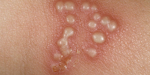 Lây truyền Herpes. Herpes là một loại bệnh mụn rộp, xuất hiện phổ biến ở các vùng như môi, mũi, má, bộ phận sinh dục và tầng sinh môn. Bệnh nguy hiểm này lây nhiễm qua 2 loại virus Herpes Simplex (HSV).