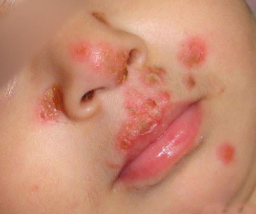 Trong đó, HSV tuýp 1 gây ra bệnh herpers miệng, môi còn HSV tuýp 2 gây ra bệnh herpers sinh dục và hậu môn. Tỷ lệ người chứa virus này khá lớn. Tại Mỹ, khoảng 70% người trưởng thành nhiễm HSV tuýp 1 trong khi HSV tuýp 2 phổ biến tới mức cứ 6 người thì có 1 đối tượng bị nhiễm.