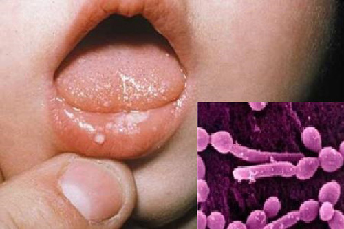Nấm má. Nấm má là một trong những căn bệnh nguy hiểm phổ biến gây ra những nốt sùi bất thường, dễ lây truyền từ người bệnh sang người lành khi môi chạm vào phần cơ thể (môi, má) đang có tổn thương do nấm.