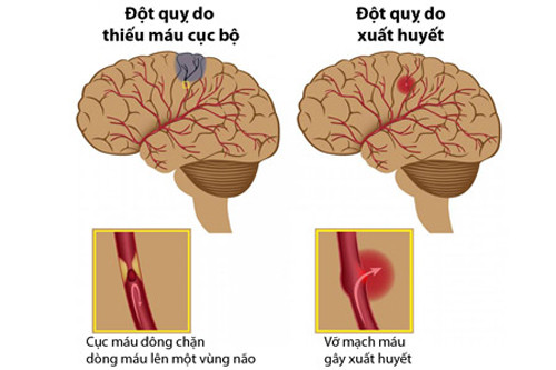 Khi dòng máu chảy về não bị ngắt quãng, một số tế bào não bị chết ngay lập tức; những tế bào não còn lại tiếp tục có nguy cơ bị chết gây ảnh hưởng nghiêm trọng đến chất lượng cuộc sống.