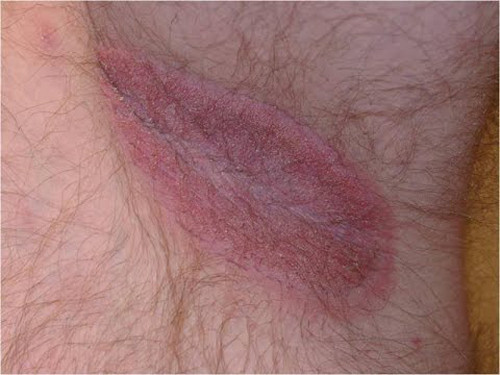 Ngứa vùng bẹn và đùi trên (Jock itch) là bệnh nhiễm trùng vùng háng do nấm. Thuật ngữ y học còn được biết đến là bệnh nấm da đùi, nấm ngoài da. Khi mắc, người bệnh thường bị nổi mẩn đỏ, ngứa quanh vùng háng, bong da, nóng rát.