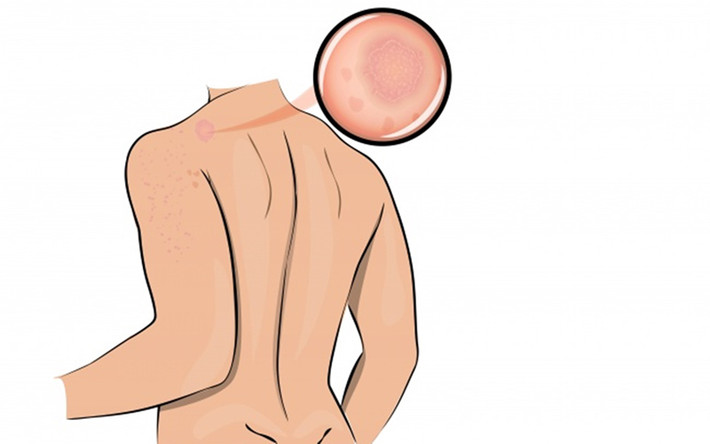 Căng thẳng stress có thể gây ra các bệnh như vẩy nến, mụn trứng cá và các bệnh ngoài da khác. Nhiều nghiên cứu được tiến hành với các sinh viên đã chứng minh mối liên quan trực tiếp giữa căng thẳng tâm lý với các bệnh về da. Một thí nghiệm tiến hành trên chuột cũng cho kết quả tương tự. Khi cơ thể chịu quá nhiều sức ép và căng thẳng, da sẽ rất dễ bị nhiễm trùng.