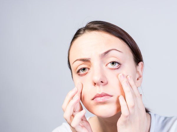 Sưng bất thường trên khuôn mặt: Bệnh nhân bị ung thư phổi sẽ xuất hiện bọng mắt, sưng hoặc đỏ trên khuôn mặt. Đây là tình trạng xảy ra do các khối u phổi tế bào nhỏ chặn các mạch máu ở ngực, ngăn máu chảy tới mặt.