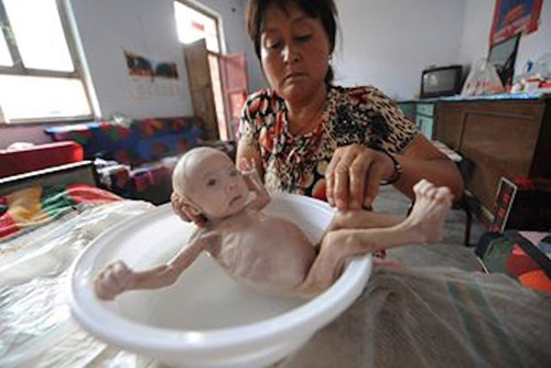 Ông nội Zhang Dongsheng của bé cho biết, Guo không được nuôi bằng sữa mẹ. Hàng ngày em chỉ được uống một chút sữa bột pha bởi việc ăn quá nhiều có thể khiến em khổ sở, đau đớn khi đi tiểu.
