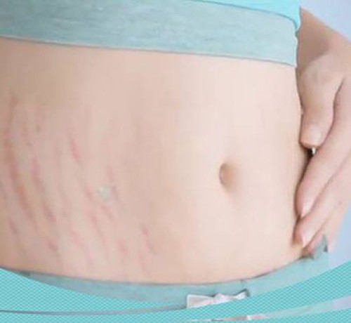 Thông thường, vết rạn hiển nhiên xung quanh vùng bụng, mông, đùi và vai đôi khi kéo dài xuống hai chân và cánh tay. Dù không phải bệnh ngoài da song vết rạn khiến chị em cảm thấy “mất phong độ” trước bạn tình hoặc khi diện các bộ đồ gợi cảm. Nếu phẫu thuật thẩm mỹ khiến bạn phải mạnh tay rút hầu bao thì những cách dưới đây lại vô cùng tiết kiệm, an toàn, hiệu quả.