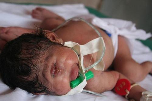 Hội chứng Cyclopia. Cyclopia là một trong những dị tật bẩm sinh hiếm gặp nhất, trong đó em bé được sinh ra với một hoặc hai mắt ở giữa trán, không có mũi và miệng. Vì vậy, hầu hết các trẻ bị Cyclopia không thể thở được bên ngoài dạ con, các em thường qua đời trước hoặc ngay sau khi được sinh ra.