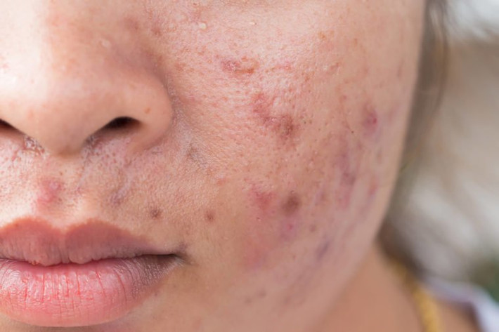 8. Bạn “nghiện” đồ ngọt Các chuyên gia cho biết việc ăn quá nhiều đường có thể khiến da xỉn màu và nhăn nheo. Khi bạn thưởng thức hương vị kem, bánh và kẹo yêu thích của mình, các phân tử đường liên kết với protein trong da, gây tổn thương cho các sợi collagen giữ cho da săn chắc và đàn hồi, tạo ra các nếp nhăn và chảy xệ.