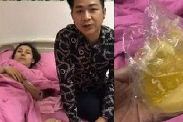 Nổ túi ngực như Ivy Trần có lẽ không còn là chuyện hiếm đối với những người phẫu thuật thẩm mỹ nâng ngực. Biến chứng luôn rình rập, và đôi khi hậu quả vô cùng khủng khiếp.