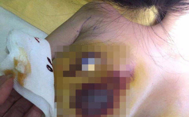 Không ít trường hợp tụ máu, nhiễm trùng có thể dẫn đến hoại tử.