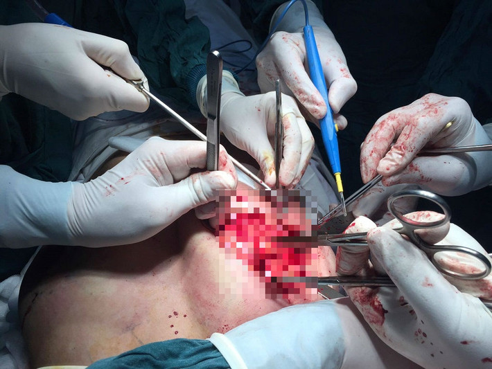 Nhiều trường hợp biến chứng nặng nề, người bệnh thậm chí phải tái phẫu thuật nhiều lần để xử lý.