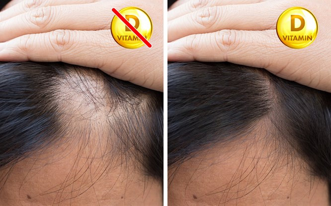 7. Rụng tóc Thiếu vitamin D khiến tóc bị suy yếu, mỏng và dễ bị rụng, khó phục hồi tóc. Vitamin D đóng một phần không thể thiếu trong quá trình tăng trưởng của tóc và nó có thể được sử dụng như một chất bổ sung nhằm điều trị rụng tóc.