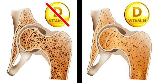 2. Loãng xươngThiếu vitamin D có thể làm giảm khả năng hấp thụ canxi ở xương, dẫn đến loãng xương, đau cơ xương… Bạn cần đảm bảo cung cấp đủ lượng vitamin D cần thiết để tránh đau xương, gãy xương và các bệnh liên quan như loãng xương.