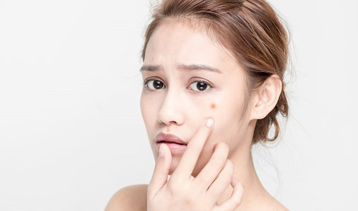 Chống và làm dịu mụn trứng cá: Nếu bạn có làn da dễ bị mụn trứng cá và đang tìm kiếm một giải pháp lâu dài tại nhà và đảm bảo an toàn thì bạn có thể sử dụng bột yến mạch. Loại bột này giúp chống lại vi khuẩn gây mụn và cung cấp các chất tăng "sức khỏe" cho làn da.