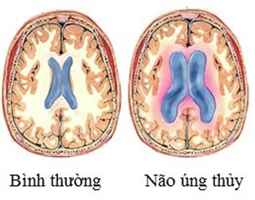 Bình thường, DNT luôn hiện diện trong não, có tác dụng giảm các sang chấn tác động từ bên ngoài vào. DNT được bộ phận rối mạch mạc tiết ra và được bộ phận khác có tên Pacchioni lấy đi.