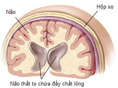 Một trong những biến chứng thường gặp nhất là tắc nghẽn hệ thống có thể xảy ra ở bất kỳ điểm nào dọc theo shunt; shunt bị lỗi hoặc đặt shunt sai vị trí.