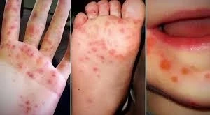 Vĩnh Long khẩn trương khống chế 5 ổ dịch tay chân miệng trong cộng đồng