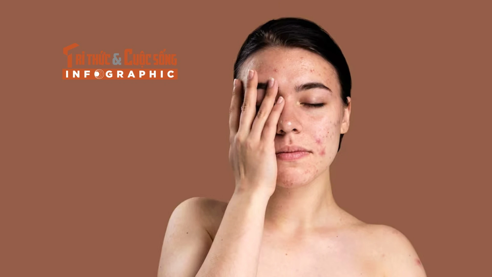 [INFOGRAPHIC] Những vấn đề về da thường gặp trong mùa hè