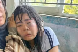 Em D.T.K (học sinh lớp 7A, Trường THCS Bình Thuận) bị bạn đánh sưng húp mặt, mắt bầm tím