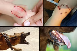 Bé 4 tuổi bị chó cắn gây thương tích nặng