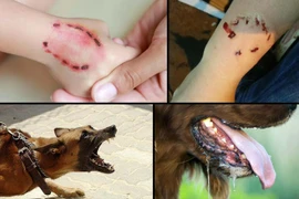 Bé 4 tuổi bị chó cắn gây thương tích nặng