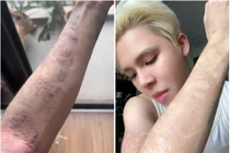 Chơi hình xăm dán, nam TikToker bị dị ứng nghiêm trọng