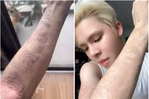 Chơi hình xăm dán, nam TikToker bị dị ứng nghiêm trọng