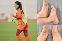 Hot girl bóng đá Hoàng Thị Loan gây xôn xao với bàn chân biến dạng