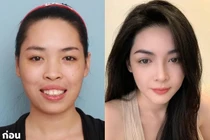 10 năm sau ca phẫu thuật 'đổi đời', Vũ Thanh Quỳnh giờ ra sao?