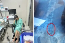 Đi ăn ốc, cô gái nuốt cả chiếc kim băng và tốn 70 triệu lấy dị vật