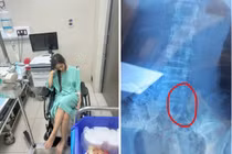 Đi ăn ốc, cô gái nuốt cả chiếc kim băng và tốn 70 triệu lấy dị vật