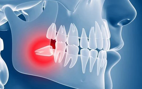 Video: Vừa chiến thắng ung thư, người phụ nữ lại mất mạng vì răng khôn