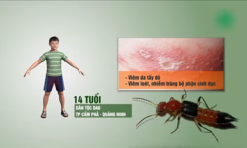 Video: Thiếu niên bị loét vùng kín do dùng rượu ngâm kiến ba khoang