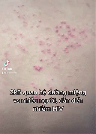 Nam sinh 16 tuổi suy sụp khi nhiễm HIV vì 1 kiểu quan hệ tình dục - Hình 2 Nam sinh 16 tuoi suy sup khi nhiem HIV vi 1 kieu quan he tinh duc-Hinh-2