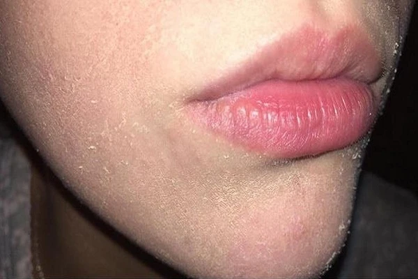 7 dấu hiệu cho thấy bạn đang bị thiếu vitamin A