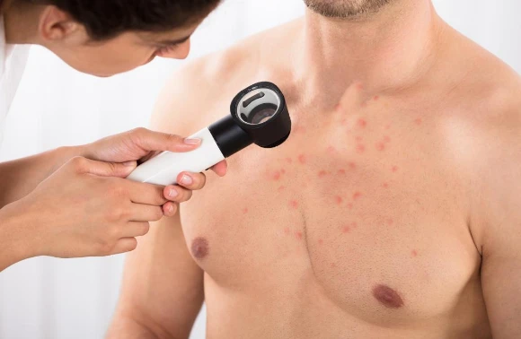 Bí quyết chữa mụn ở ngực cho nam