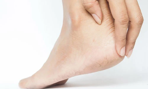 Nguyên nhân hàng đầu khiến gót chân dễ bị nứt nẻ