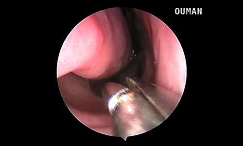 Video: Bác sỹ gắp con vắt sống trong lỗ mũi hơn 1 tháng