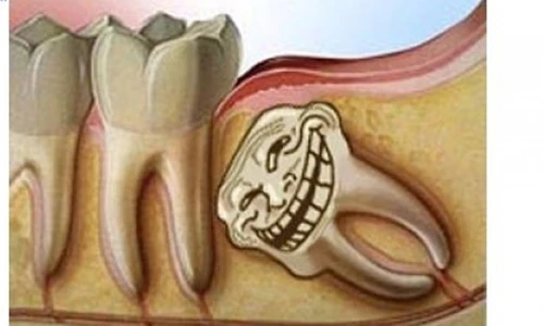 Video: Sự tích răng khôn và vì sao chúng hành hạ con người đến vậy?