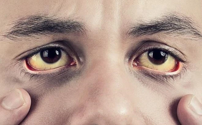 Video: Triệu chứng bất thường ở mắt không nên bỏ qua