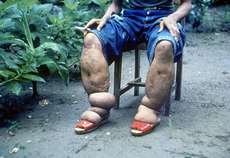 Và đây là biểu hiện bên ngoài của người bị nhiễm giun chỉ nặng.