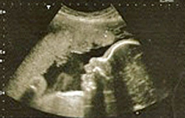 Người phụ nữ may mắn này tên là Nicola Weller, 29 tuổi. Cô phải nhập viện để phẫu thuật cắt bỏ một khối u trong tử cung. Nhưng thật không ngờ, kết quả xét nghiệm cho thấy cô đã mang thai.