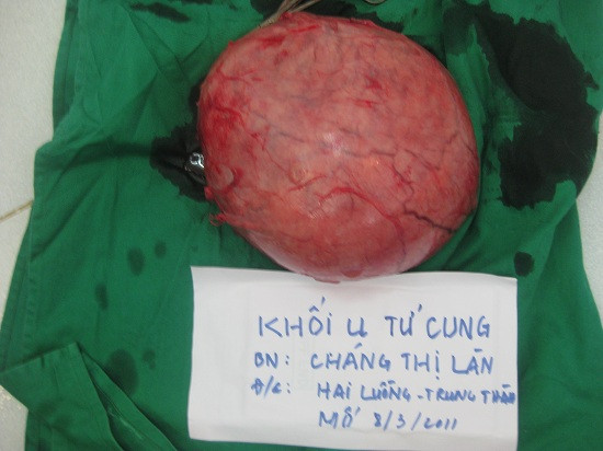 Tại Việt Nam, các bác sĩ cũng đã phẫu thuật thành công cắt bỏ khối u xơ tử cung nặng gần 4kg của bà Chàng Thị Làn, Hà Giang vào năm 2011.
