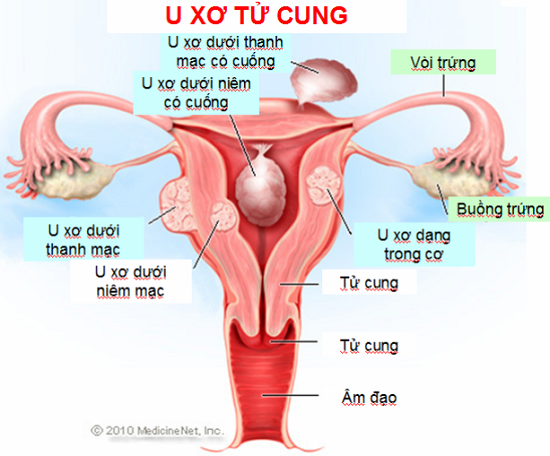 U xơ cổ tử cung là một loại u xơ phát triển từ trong cổ tử cung của người phụ nữ. Đó thường là những khối u nhỏ và lành tính.