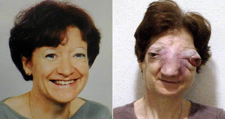 Chantal Sebire mắc phải một dạng ung thư hiếm gặp có tên khoa học là esthesioneuroblastoma. Sebire từ chối mọi phương pháp điều trị và đã qua đời tại nhà vào năm 2008. Nguyên nhân cái chết của bà được chẩn đoán là do dùng thuốc trợ tử.