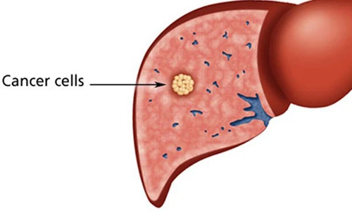 Điểm danh 10 căn bệnh ung thư nguy hiểm nhất
