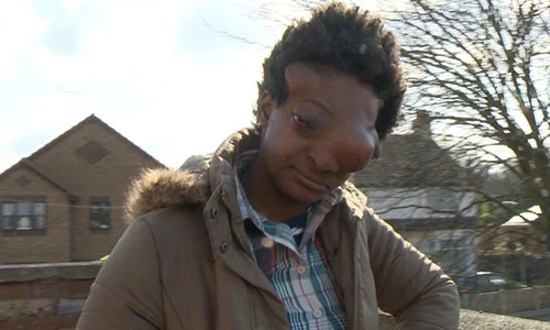 Thảm cảnh gái xinh biến dạng vì khối u trùm kín mặt