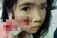 Bé gái ở Quảng Trị bị khỉ hoang tấn công gây thương tích